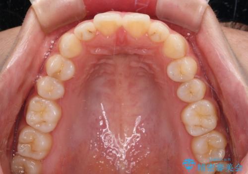 インビザラインを用いた上顎の部分矯正の治療後