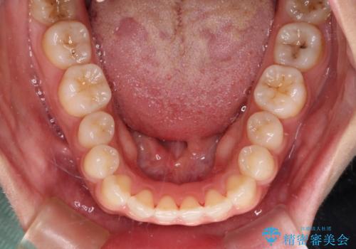 インビザラインを用いた上顎の部分矯正の治療後