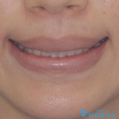 インビザラインを用いた上顎の部分矯正の治療後(顔貌)