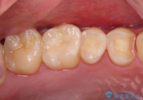 詰め物が外れた セラミックインレー修復の治療中