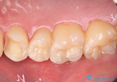 詰め物が外れた セラミックインレー修復の治療中