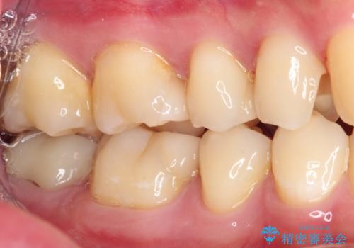 詰め物が外れた セラミックインレー修復の治療中