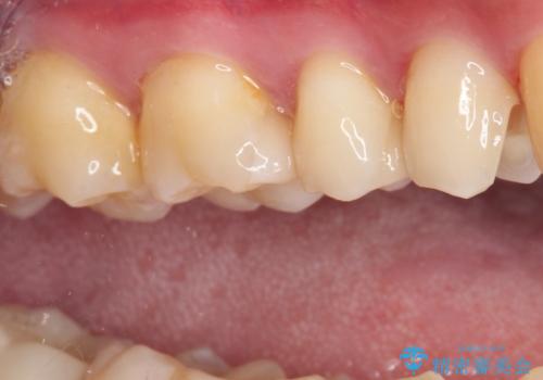 詰め物が外れた セラミックインレー修復の治療中