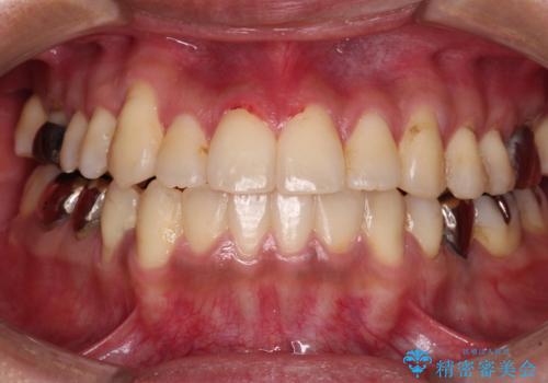 前歯のクロスバイトを改善　インビザライン矯正の症例 治療後