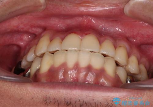 前歯のクロスバイトを改善　インビザライン矯正の治療後