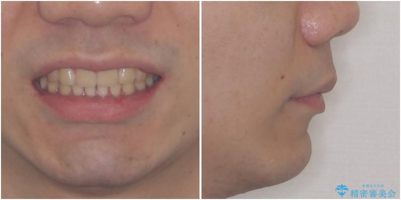強い咬み合わせで飛び出した前歯　インビザライン矯正で改善の治療後（顔貌）