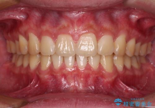 強い咬み合わせで飛び出した前歯 インビザライン矯正で改善