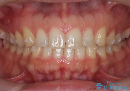 前歯の目立ったすき間 マウスピース矯正で目立たなくしますの治療中