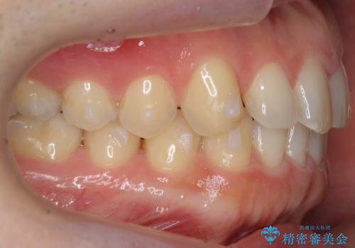 前歯の目立ったすき間 マウスピース矯正で目立たなくしますの治療中