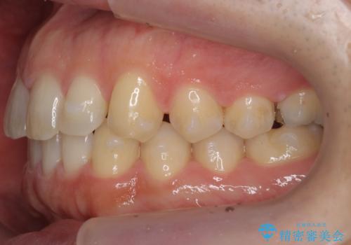 前歯の目立ったすき間 マウスピース矯正で目立たなくしますの治療中