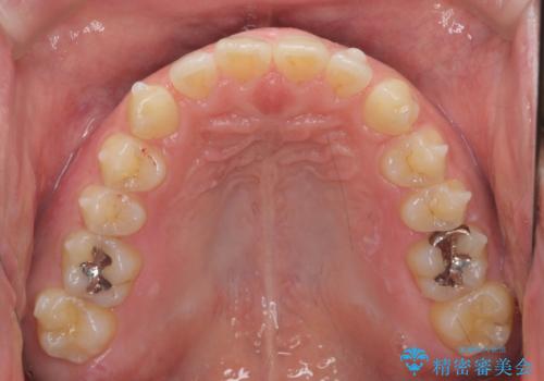 前歯の目立ったすき間 マウスピース矯正で目立たなくしますの治療中
