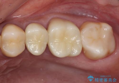 治療中放置してしまった奥歯 セラミック治療の治療後
