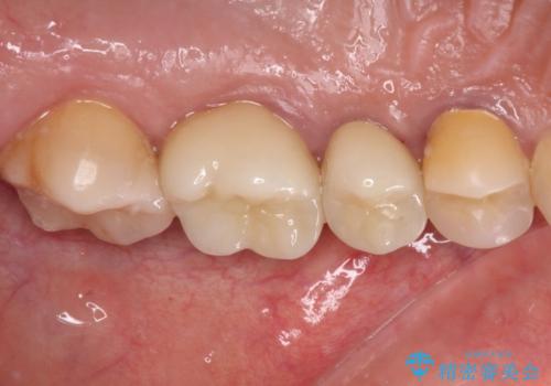 治療中放置してしまった奥歯 セラミック治療の治療後