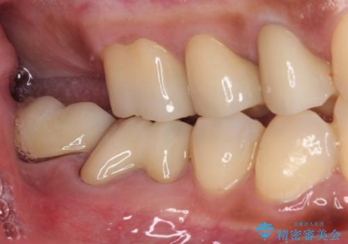 治療中放置してしまった奥歯 セラミック治療の治療後