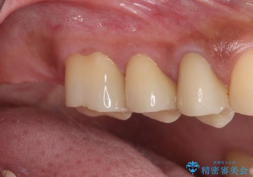 治療中放置してしまった奥歯 セラミック治療の治療後