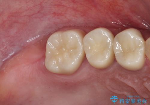 治療中放置してしまった奥歯 セラミック治療の治療後
