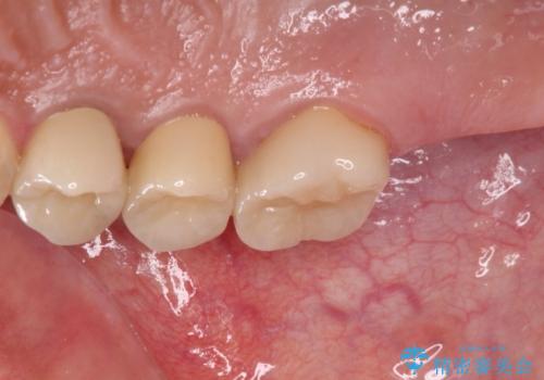 治療中放置してしまった奥歯 セラミック治療の治療後