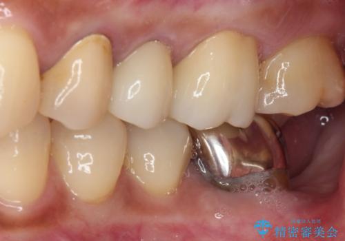 治療中放置してしまった奥歯 セラミック治療の治療後