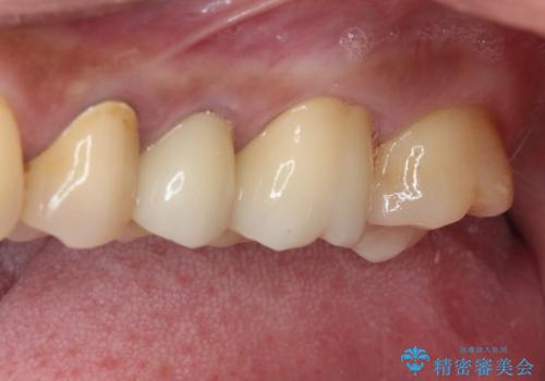 治療中放置してしまった奥歯 セラミック治療の治療後