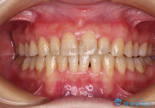 前歯のデコボコと奥歯のクロスバイト　インビザラインで改善の症例 治療後
