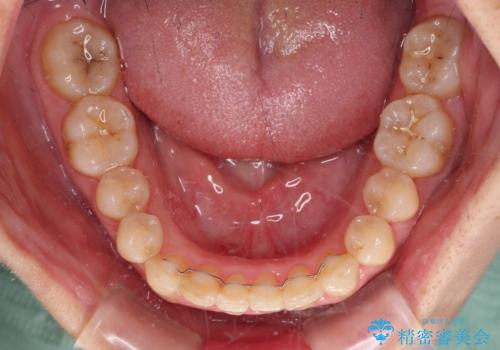 前歯のデコボコと奥歯のクロスバイト　インビザラインで改善の治療後