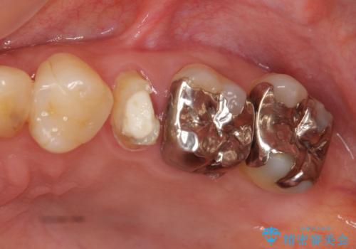 他院で抜歯と言われた 残したいの治療前