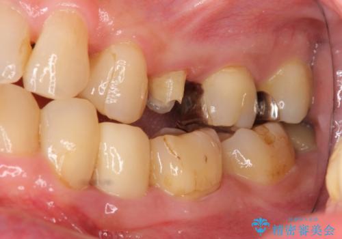 他院で抜歯と言われた 残したいの治療前