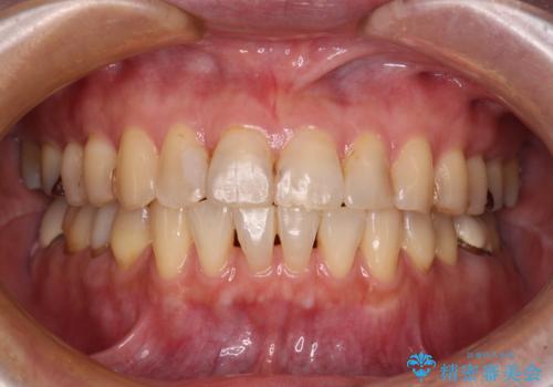 インビザラインは面倒くさい 目立たないワイヤー装置による矯正治療