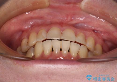 インビザラインは面倒くさい 目立たないワイヤー装置による矯正治療の治療後
