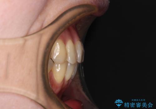 インビザラインは面倒くさい 目立たないワイヤー装置による矯正治療の治療後