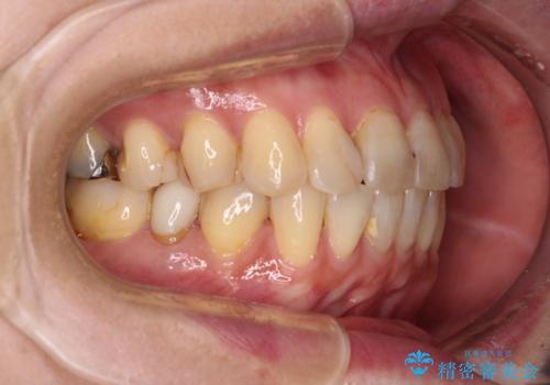 インビザラインは面倒くさい 目立たないワイヤー装置による矯正治療の治療後