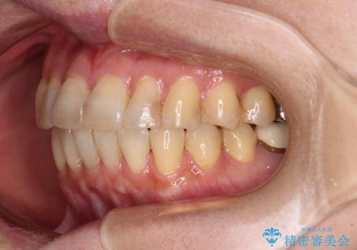 インビザラインは面倒くさい 目立たないワイヤー装置による矯正治療の治療後