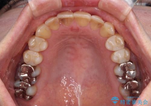 インビザラインは面倒くさい 目立たないワイヤー装置による矯正治療の治療後