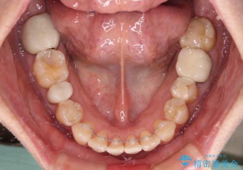 インビザラインは面倒くさい 目立たないワイヤー装置による矯正治療の治療後