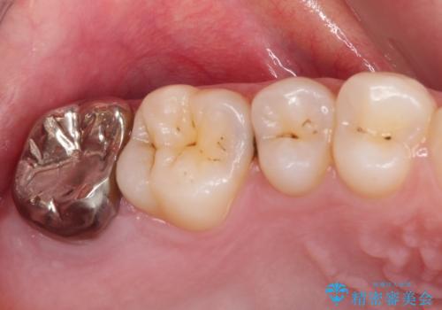 不快感が続く奥歯 外科処置を併用したセラミック補綴治療の症例 治療前