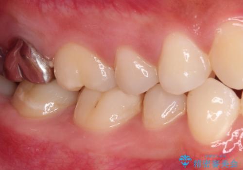 不快感が続く奥歯 外科処置を併用したセラミック補綴治療の治療前
