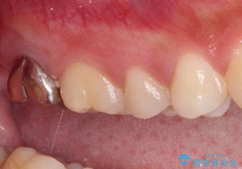 不快感が続く奥歯 外科処置を併用したセラミック補綴治療の治療前