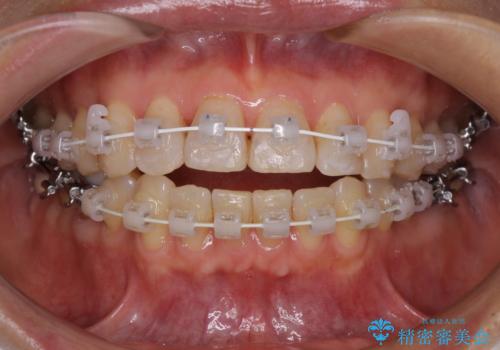 インビザラインは面倒くさい 目立たないワイヤー装置による矯正治療の治療中