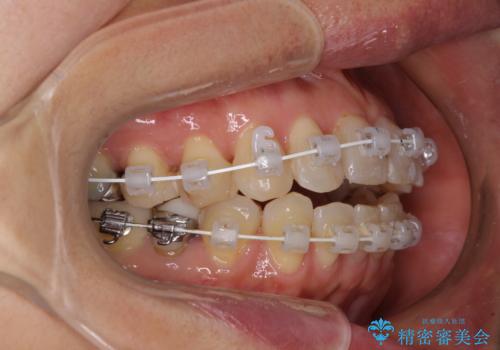 インビザラインは面倒くさい 目立たないワイヤー装置による矯正治療の治療中