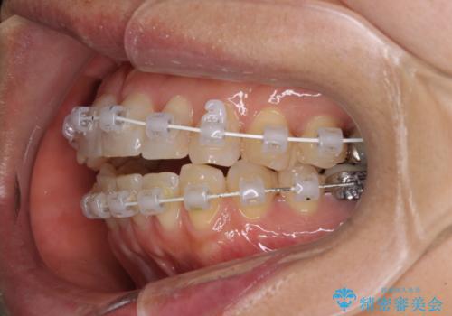 インビザラインは面倒くさい 目立たないワイヤー装置による矯正治療の治療中