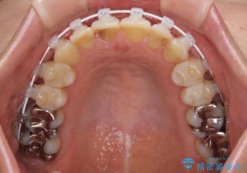 インビザラインは面倒くさい 目立たないワイヤー装置による矯正治療の治療中