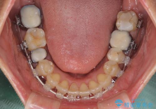 インビザラインは面倒くさい 目立たないワイヤー装置による矯正治療の治療中