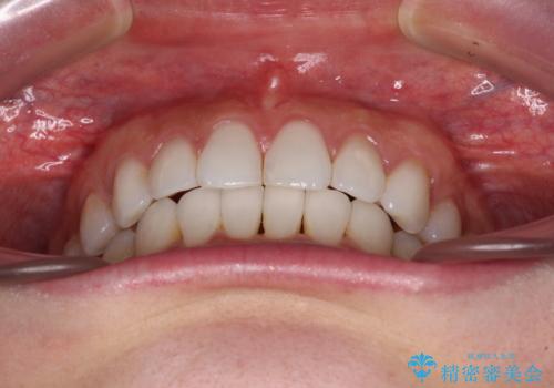 海外で仕事をしながらインビザラインで矯正治療の治療後