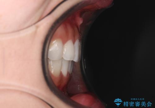 海外で仕事をしながらインビザラインで矯正治療の治療後