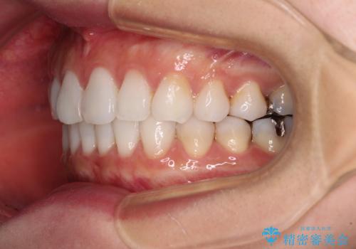 海外で仕事をしながらインビザラインで矯正治療の治療後