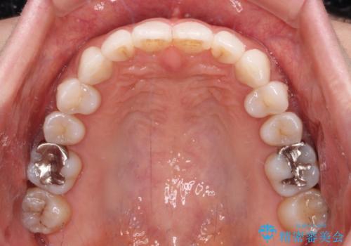 海外で仕事をしながらインビザラインで矯正治療の治療後