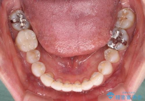 海外で仕事をしながらインビザラインで矯正治療の治療後