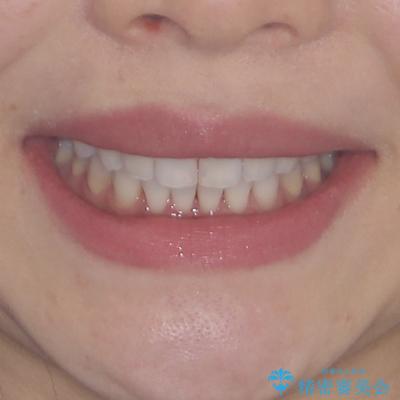 海外で仕事をしながらインビザラインで矯正治療の治療後(顔貌)