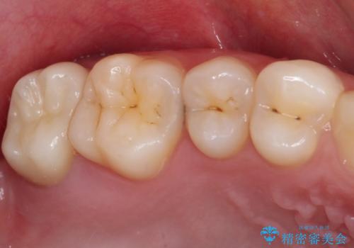 不快感が続く奥歯 外科処置を併用したセラミック補綴治療の症例 治療後