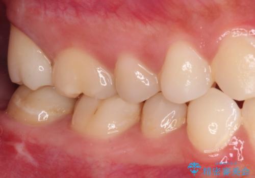不快感が続く奥歯 外科処置を併用したセラミック補綴治療の治療後